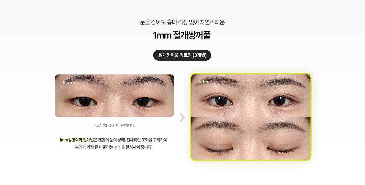 1mm 성형외과 홈페이지 화면